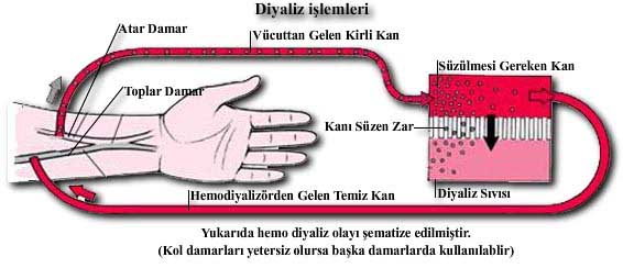 Böbrek Yetmezliğinde Diyaliz